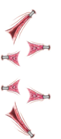 Stretched - Trauma Tattoos - Image 3