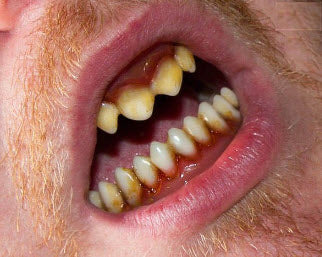 Teeth FX - Image 2